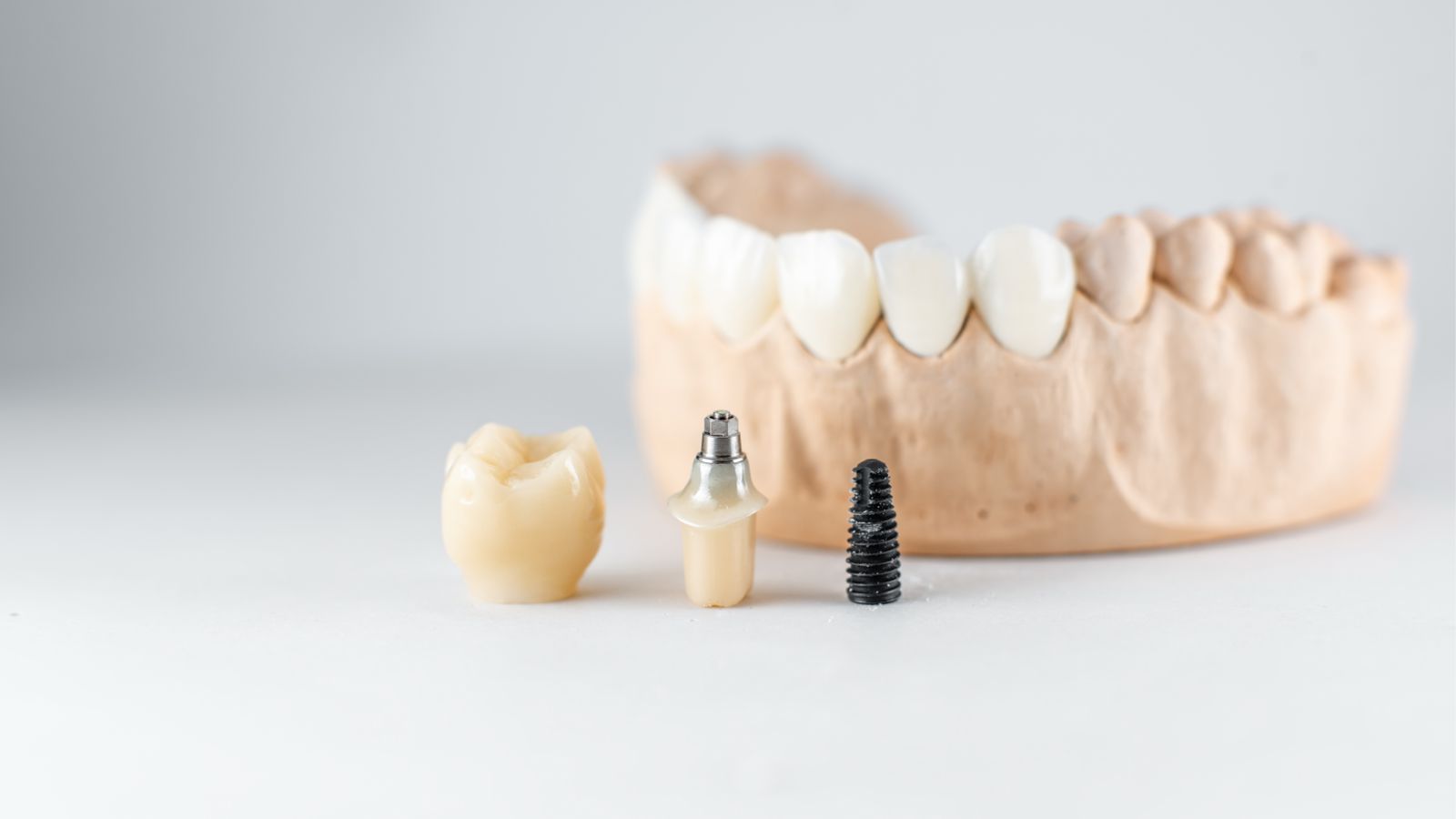 What Are All-on-4 and All-on-6 Dental Implant Treatments?